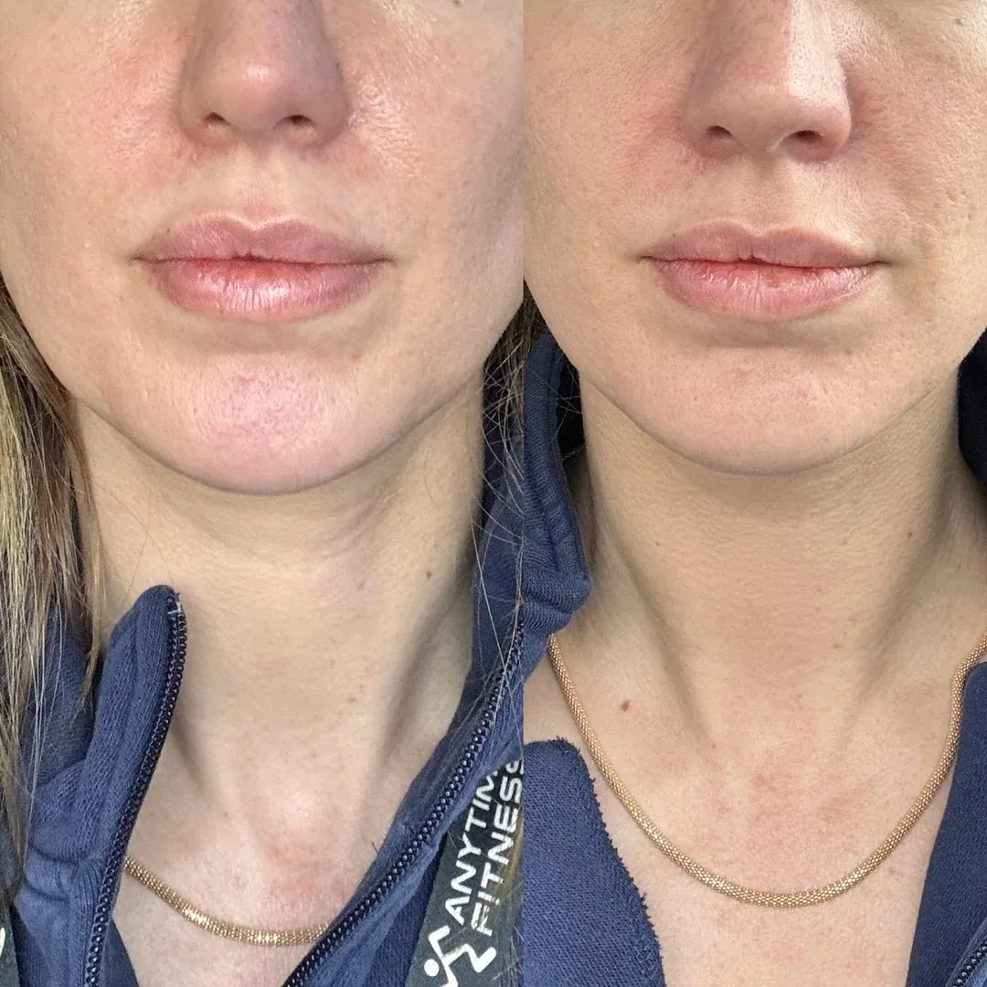 Efekty stosowania Dermify — klientka 1