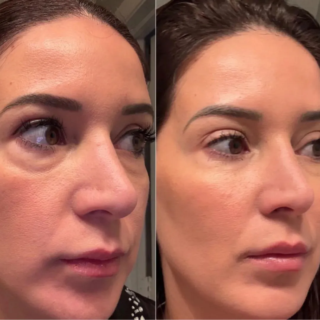 Efekty stosowania Dermify — klientka 2